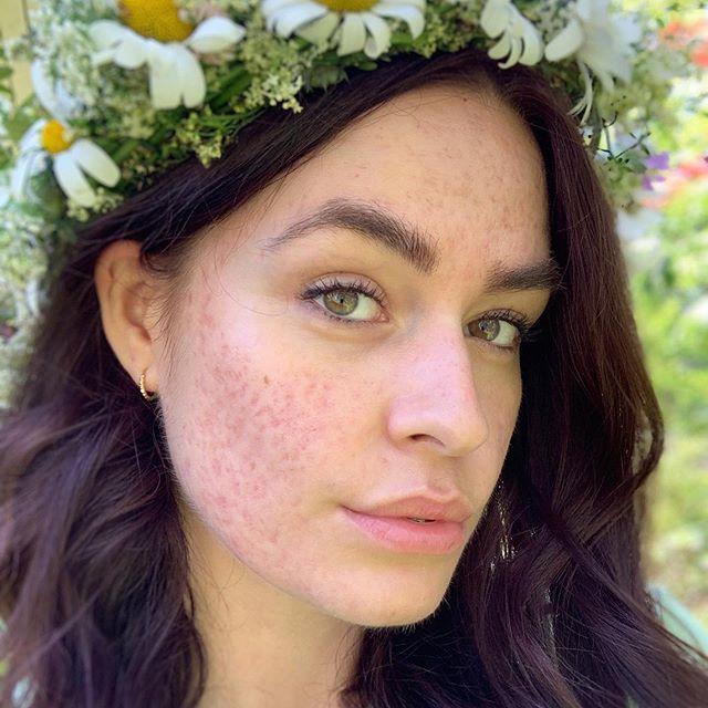 Sofia: Skin Positivity & Self-love