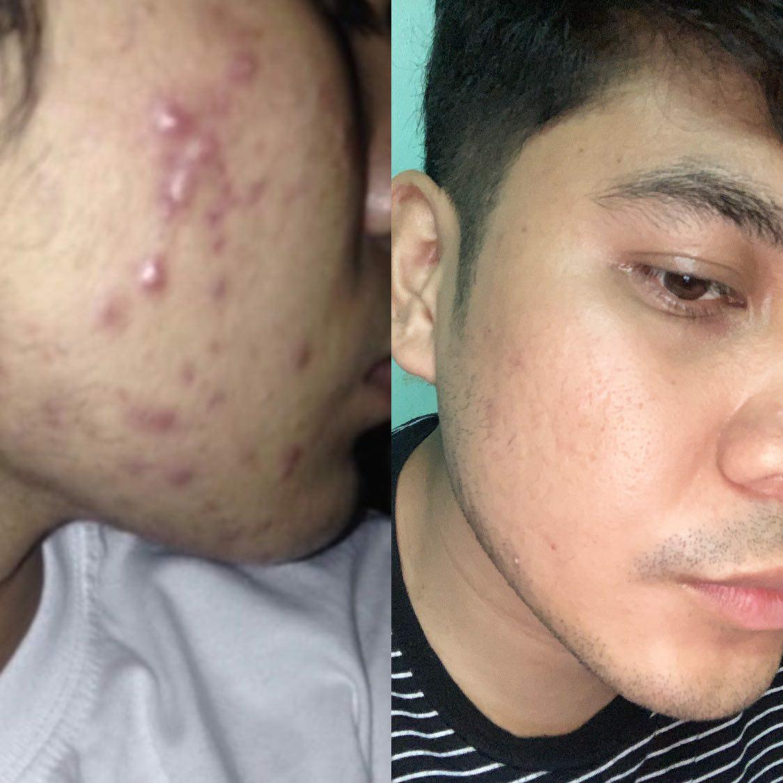 Ruzzel's Acne Story