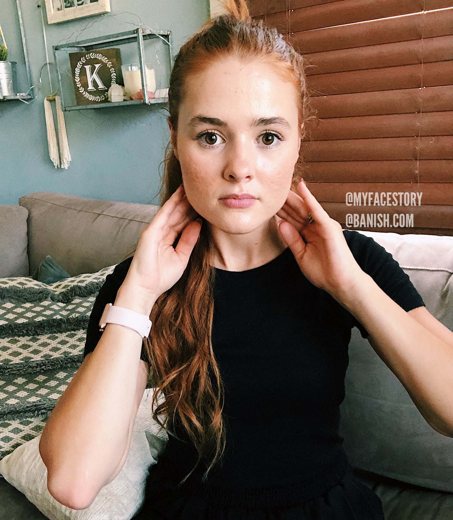 Treating Acne Through Lymphatic Drainage