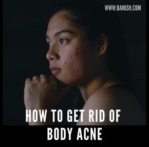 how to get rid of body acne