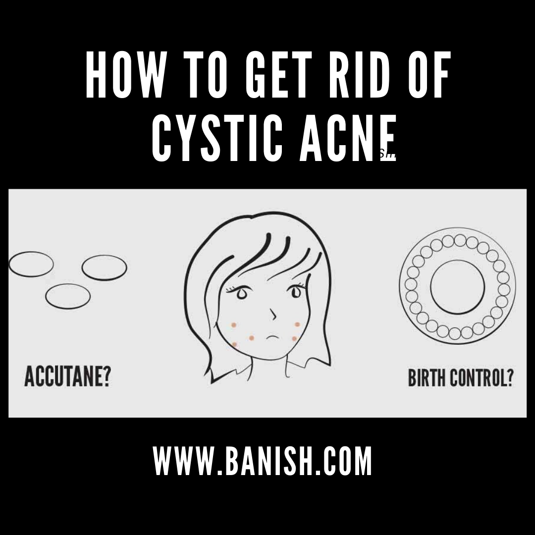 how to get rid of cystic acne