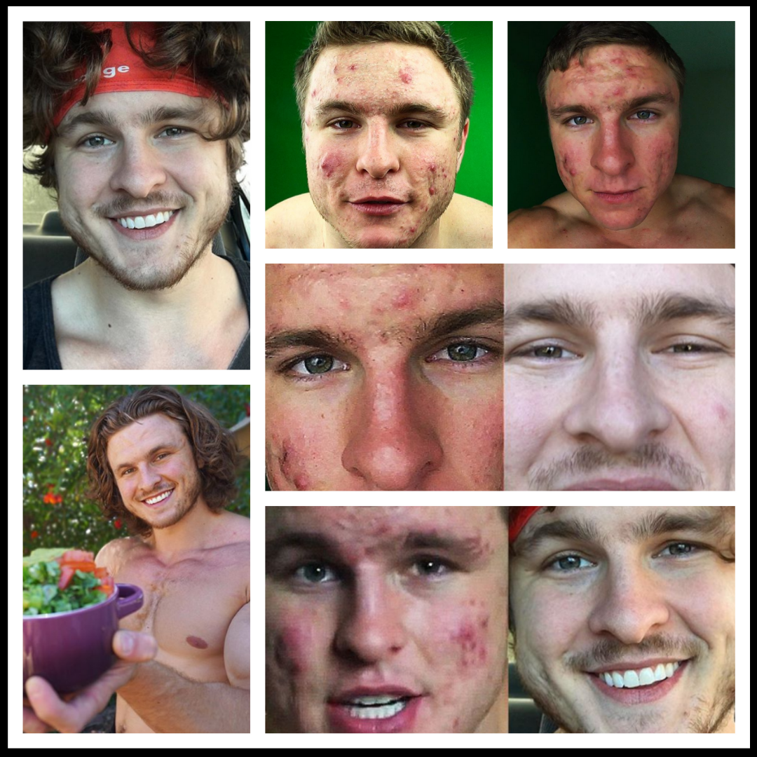 How Brian Turner Cured His Acne