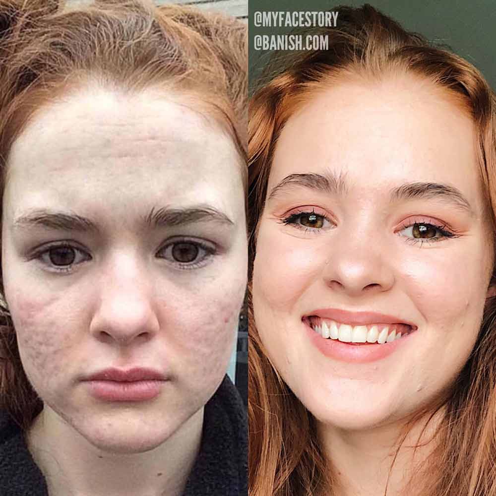 First, identify what you call an acne scar