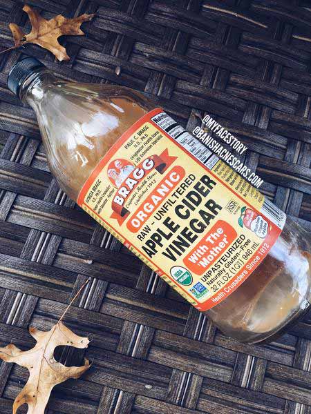 apple cider vinegar for acne