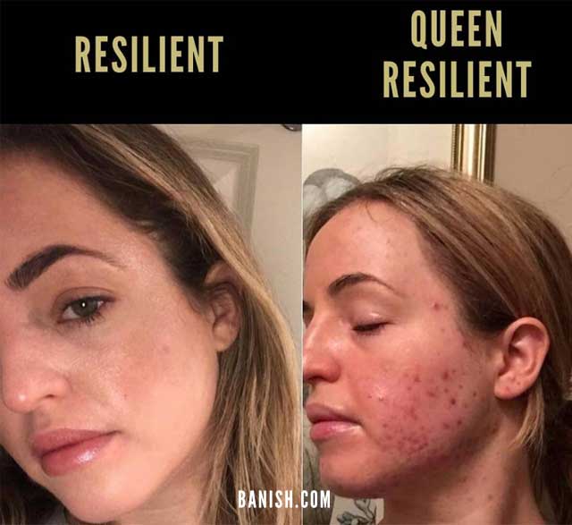 DISCOVER HOW TO CURE ACNE | banish before after meredith