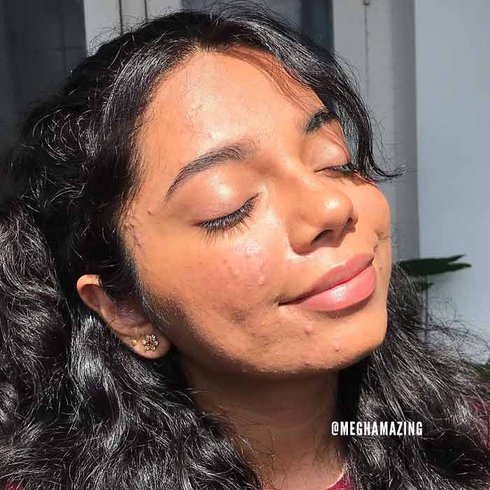 acne is normal