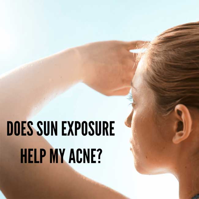 sun exposure and acne