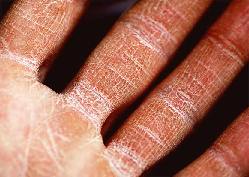 dehydrated skin