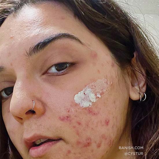 Signs that acne may be hormone-related