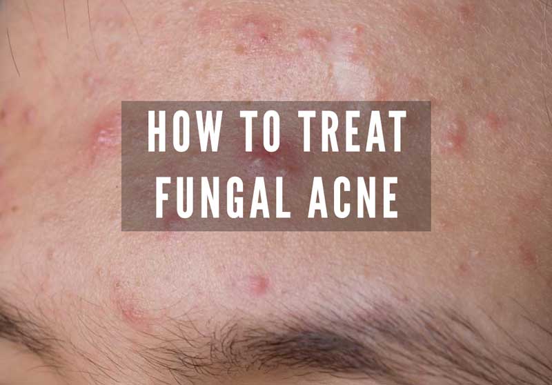 fungal acne
