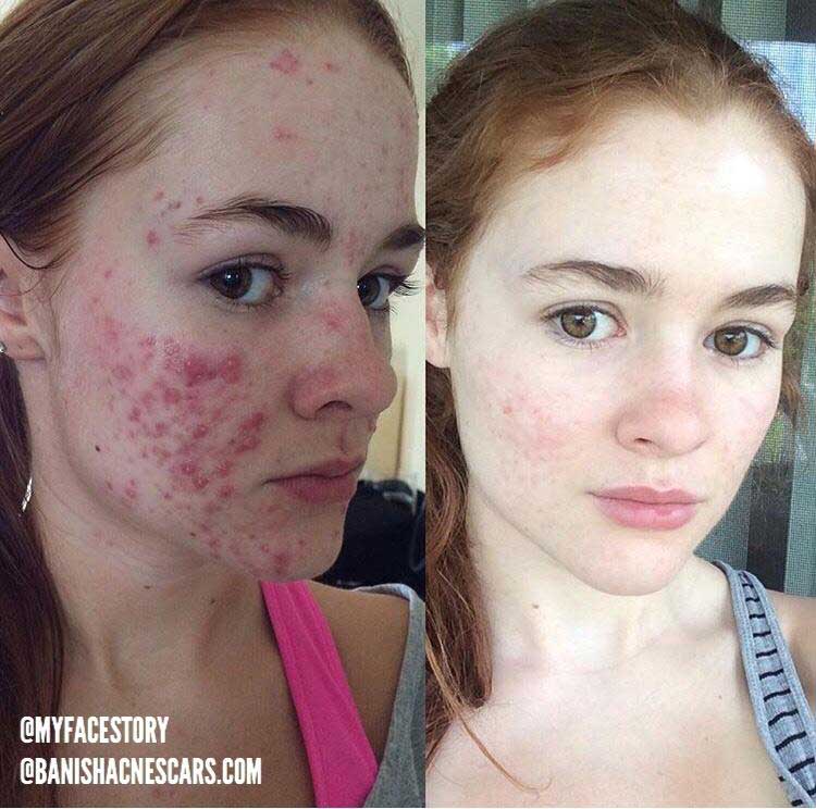 Myths about stress and acne