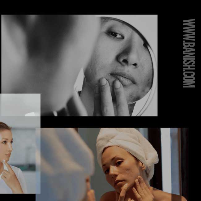 why are acne scars getting worse