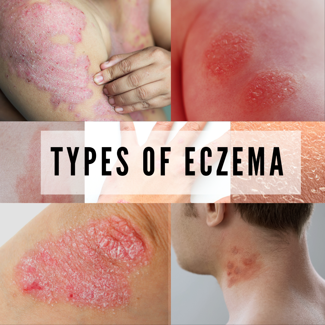 types of eczema