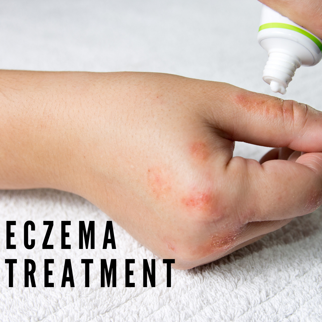 eczema