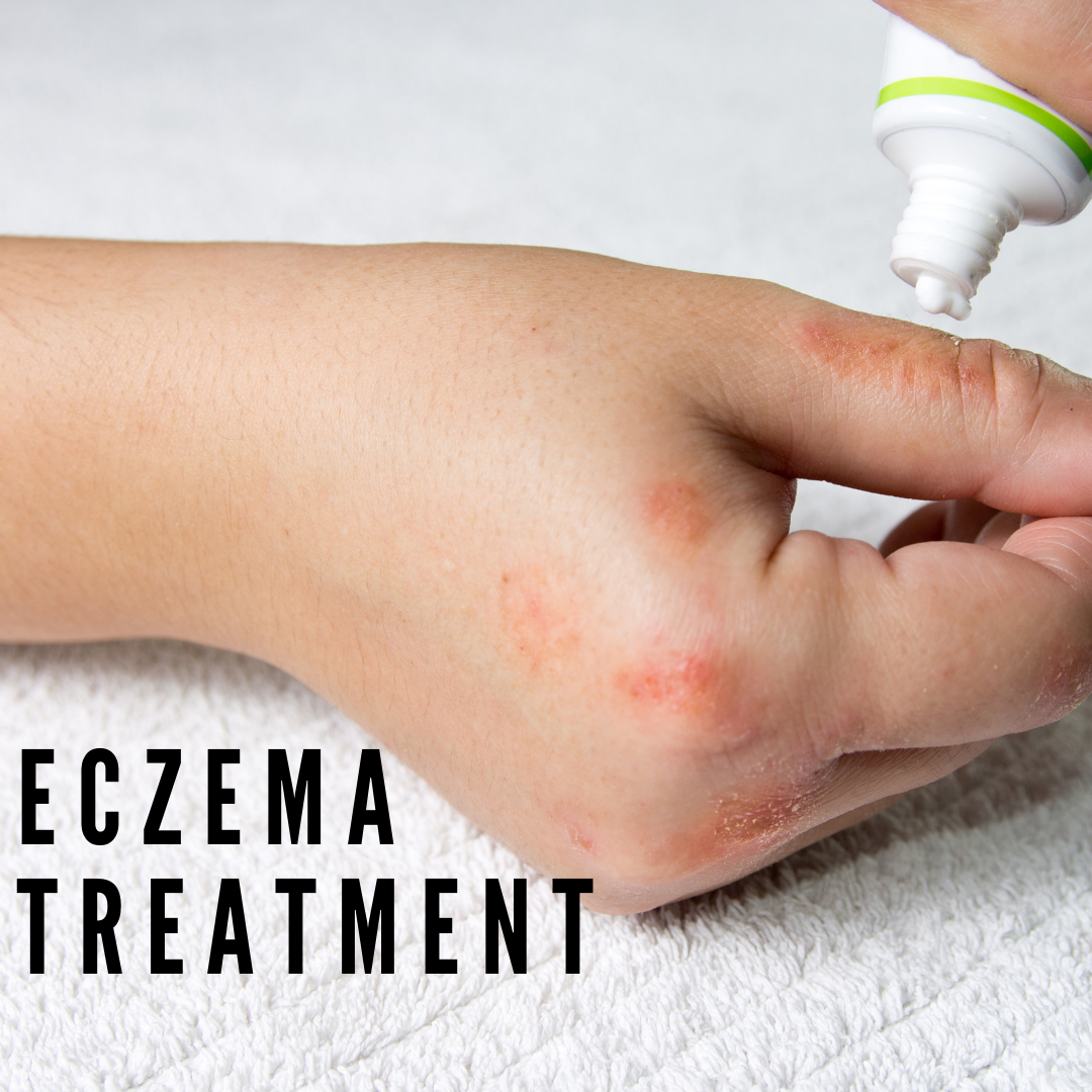 eczema 