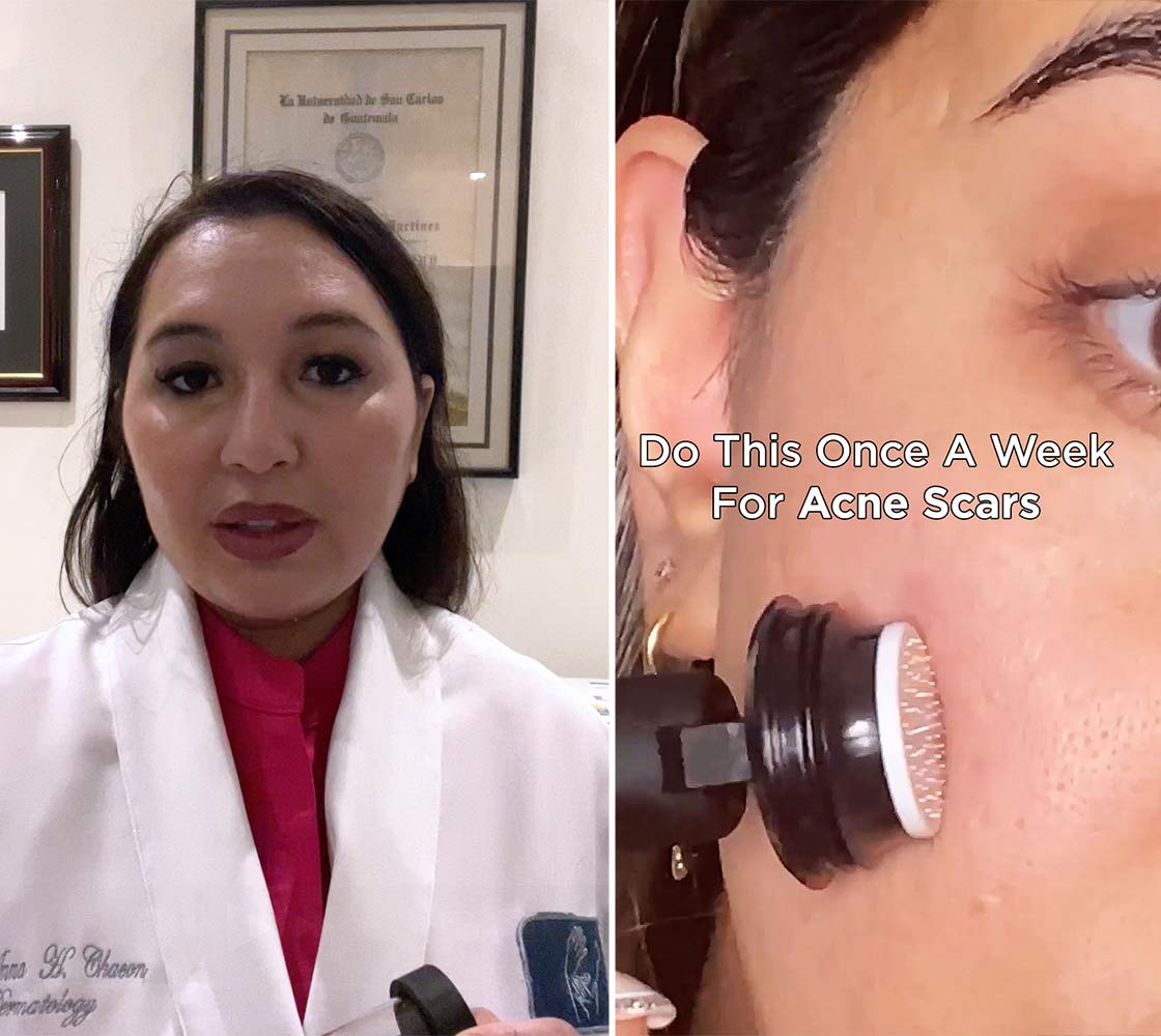 dermatologist guide to microneedling