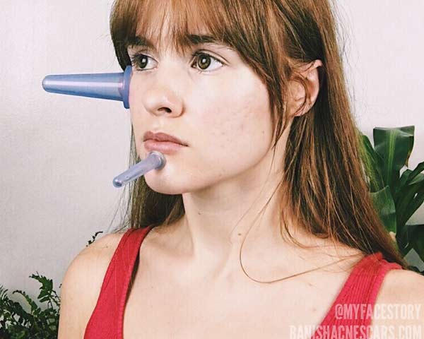 facial cupping