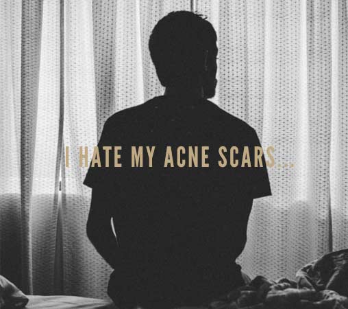 hate my acne scars blog