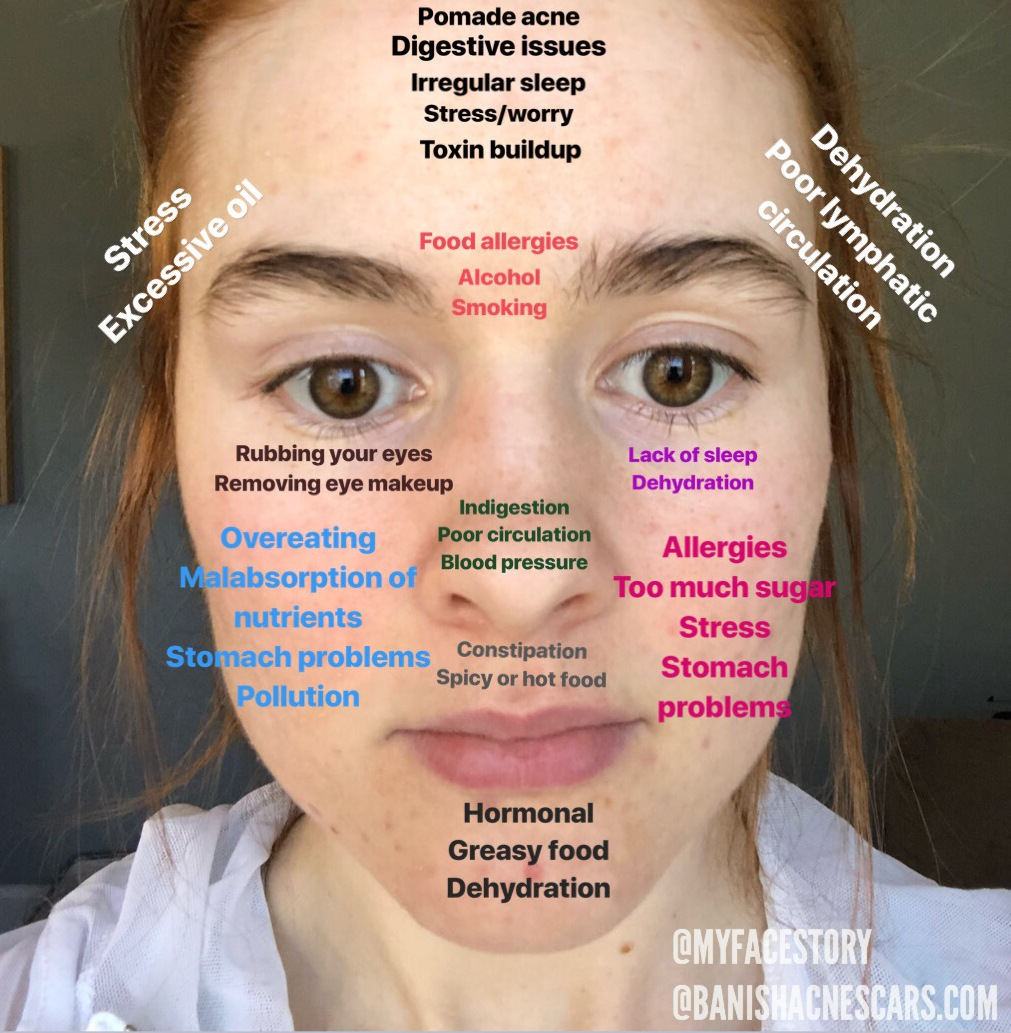 Spots on different parts of the face: Meaning & Causes