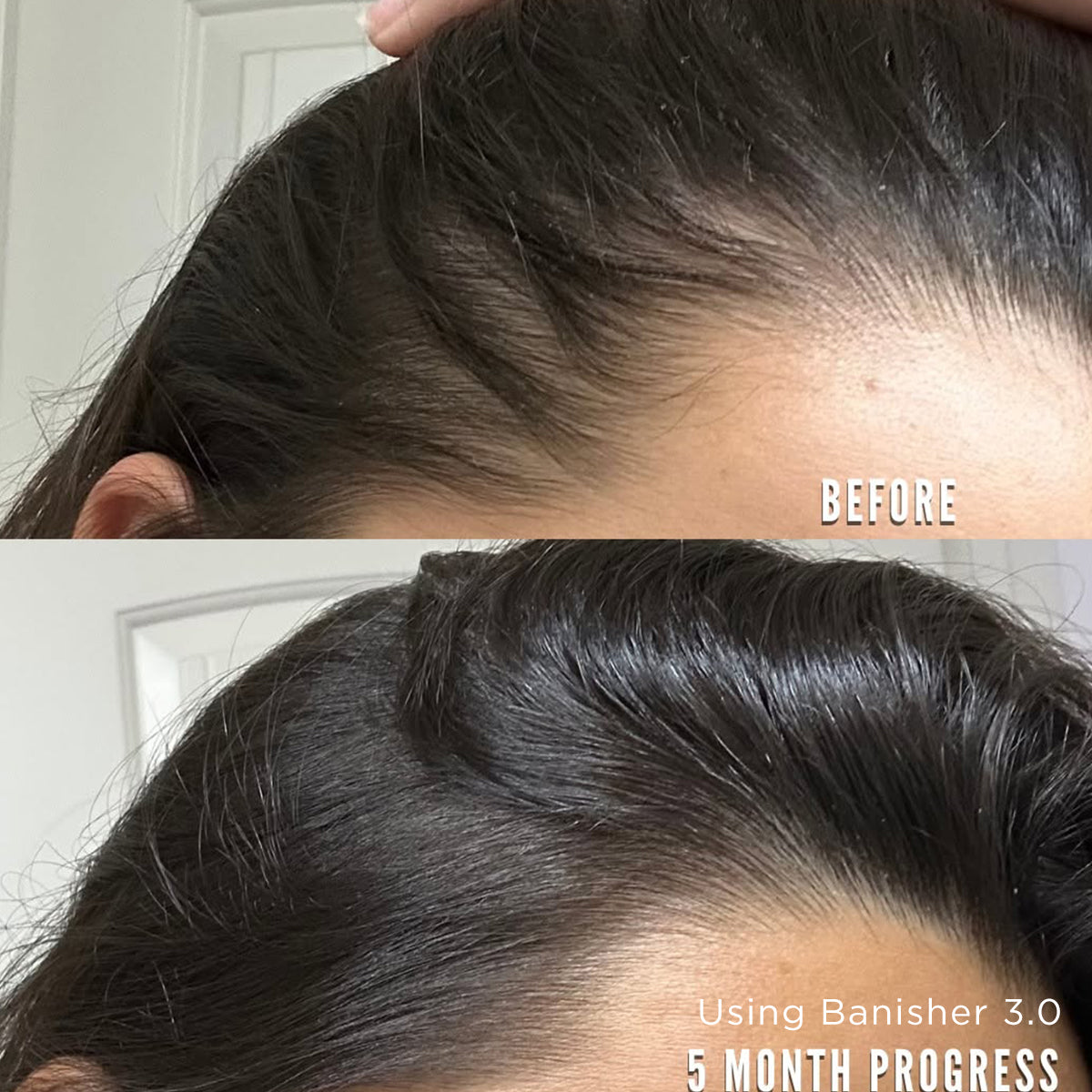 Microneedling for Hair Growth: What the Research Says