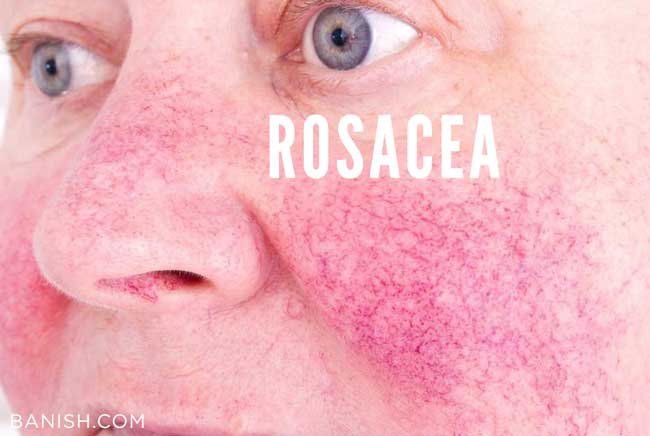 rosacea