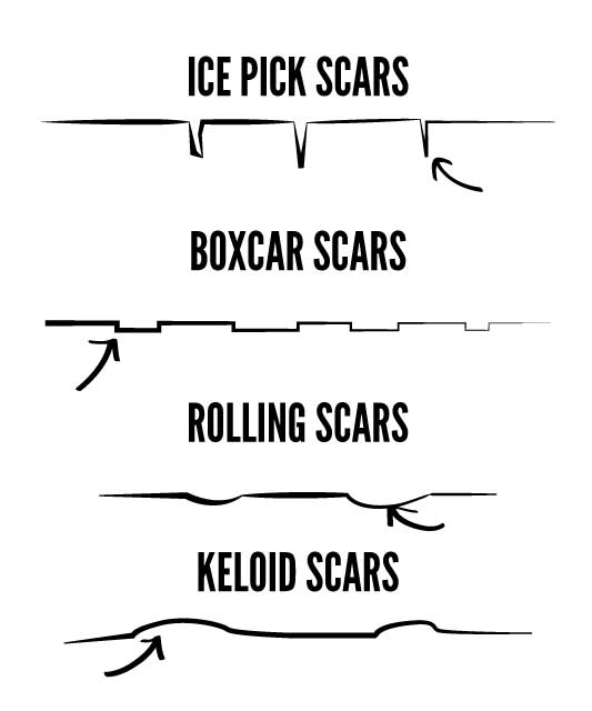 types of acne scars