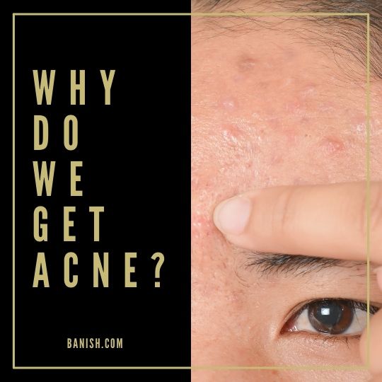 why do we get acne