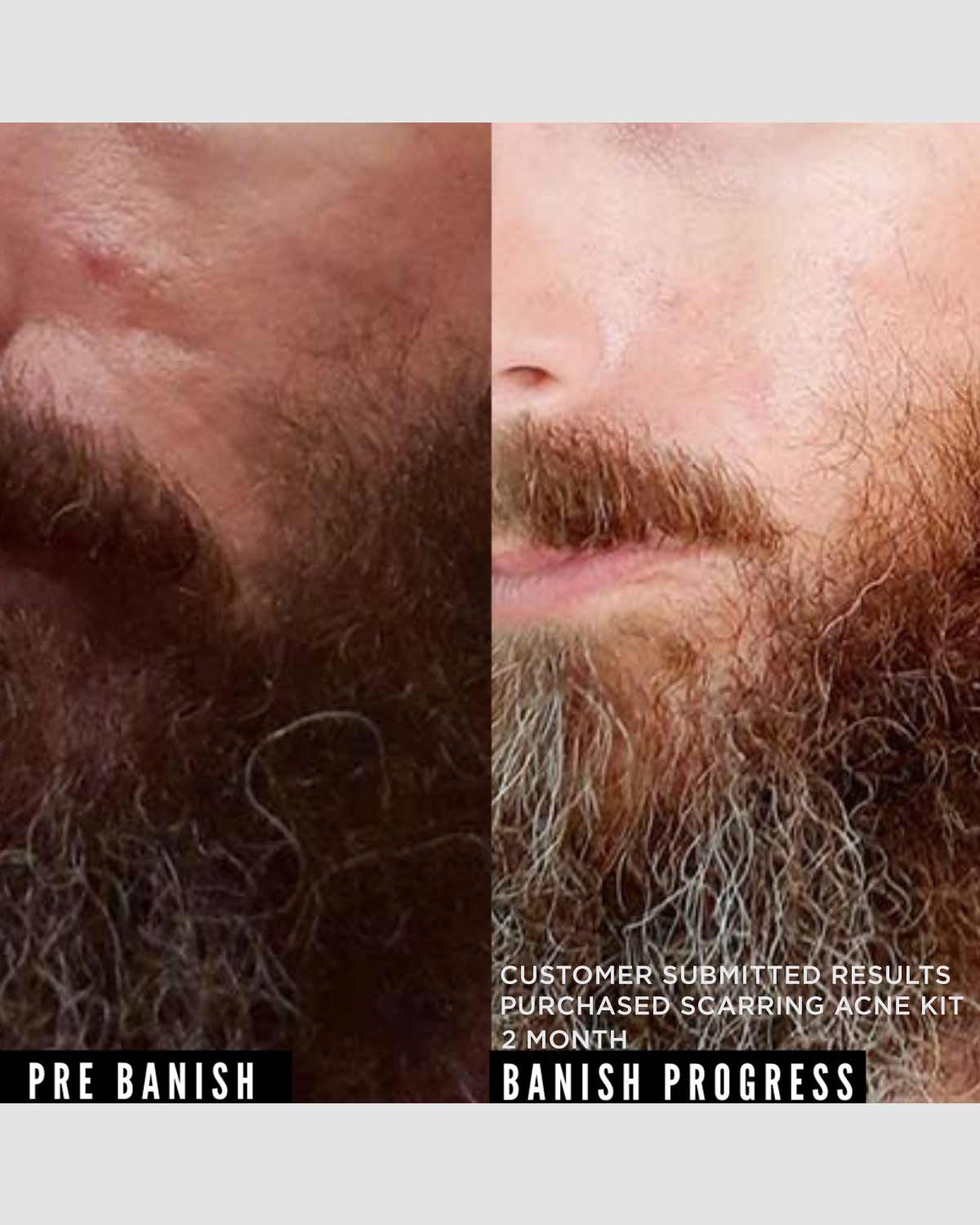 banish acne scarring kit results on man