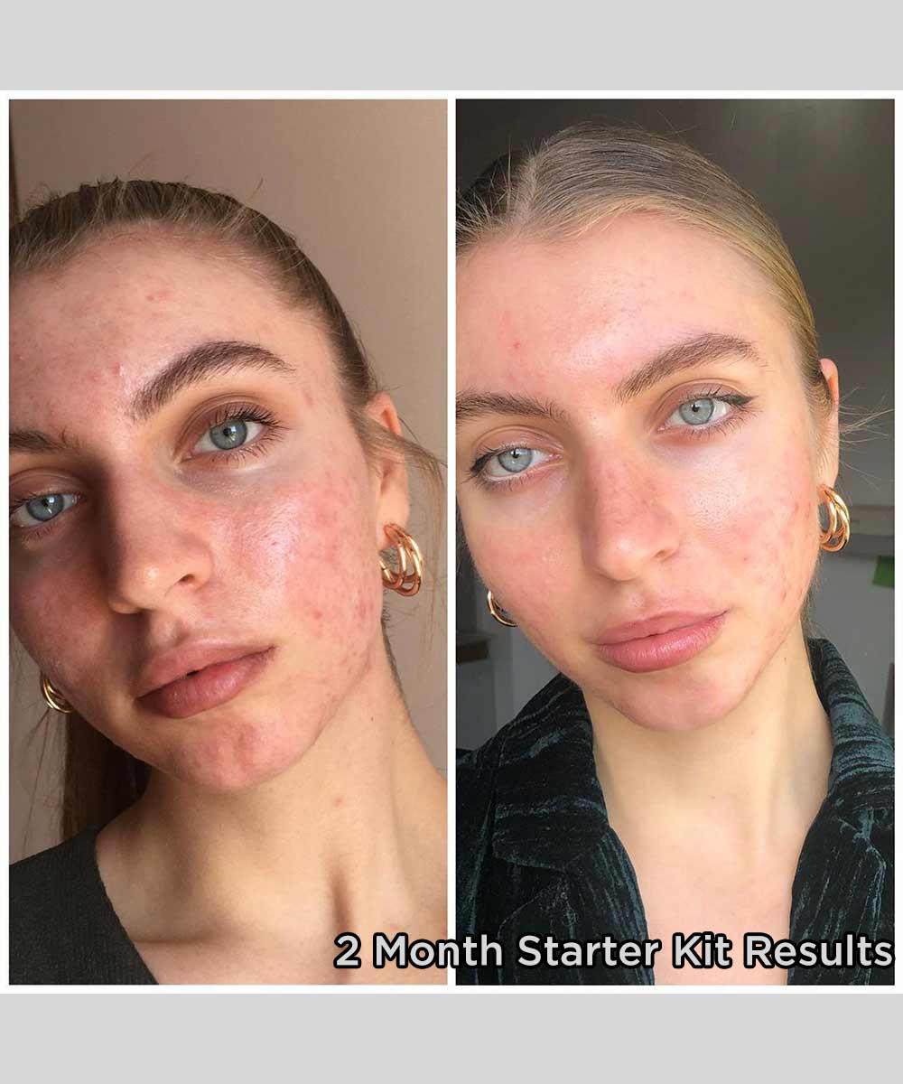 banish starter kit 2 month results
