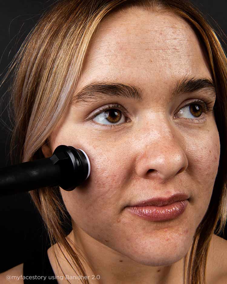 Banisher 2.0 microneedle on kali myfacestory