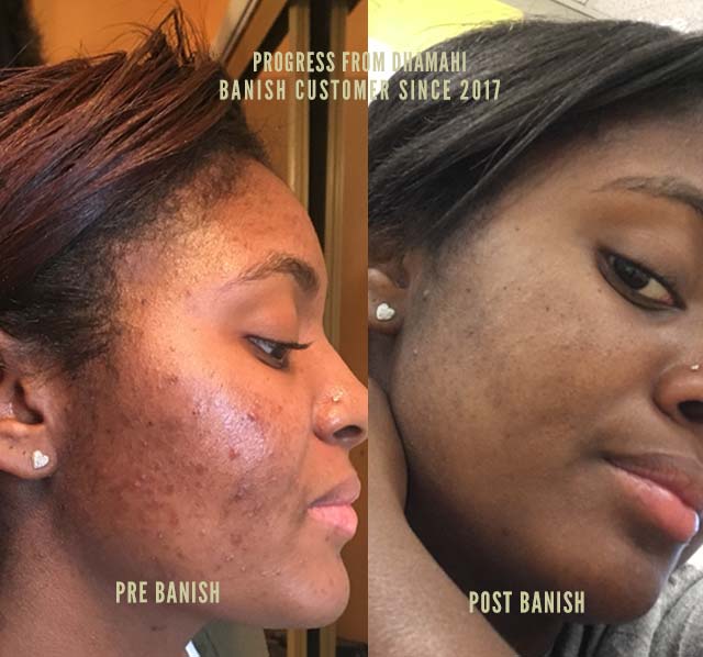 banish vitamin c creme before after