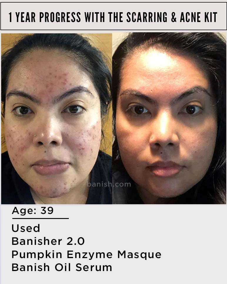 Scarring and Acne Kit