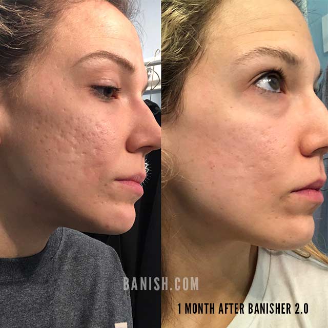 before and after banisher 2.0 1 month after