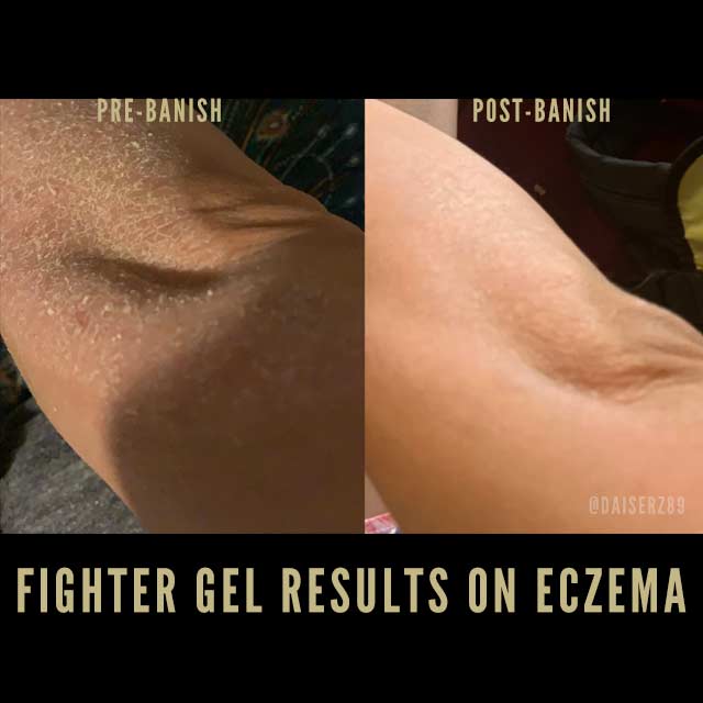 fighter gel for eczema