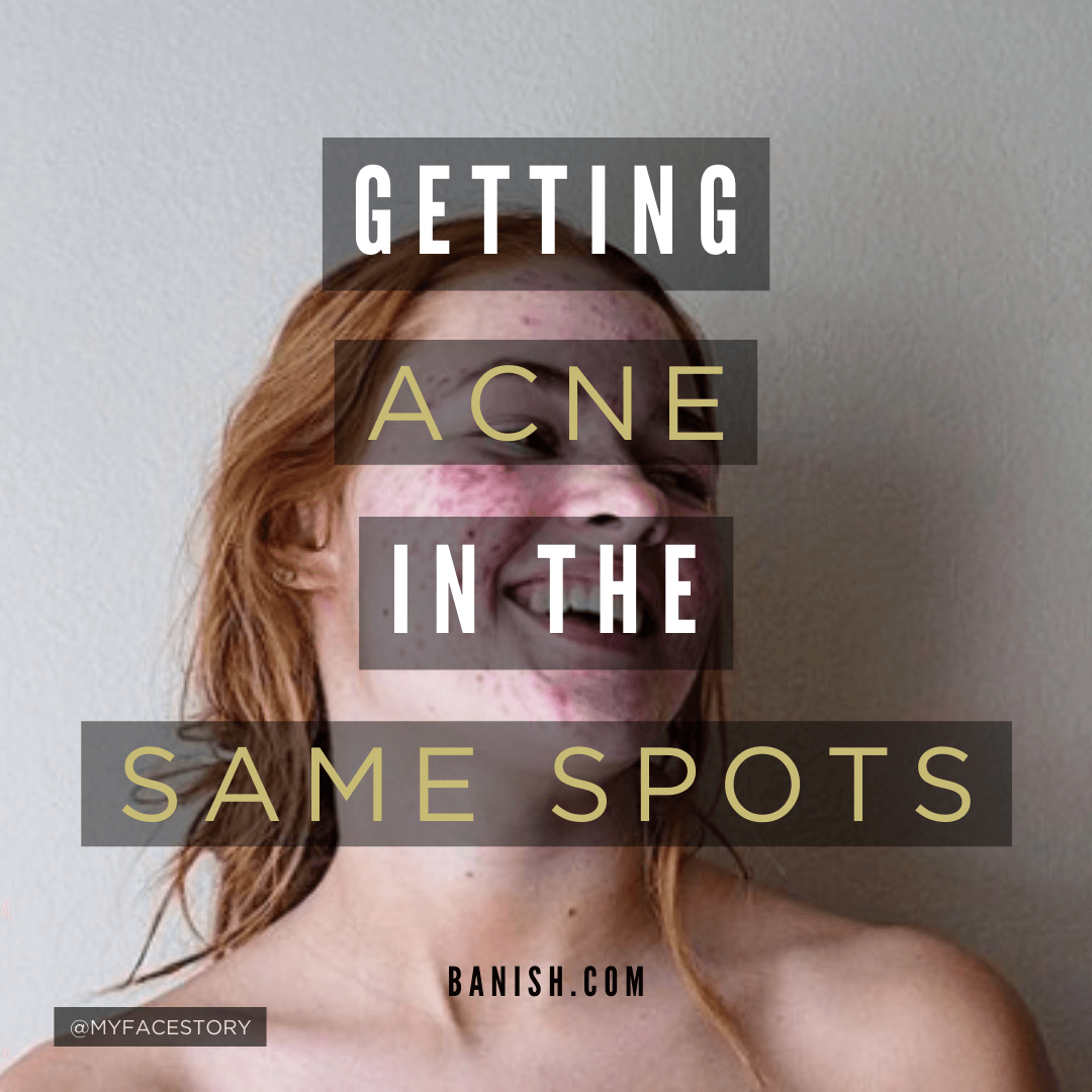 getting acne in the same spots