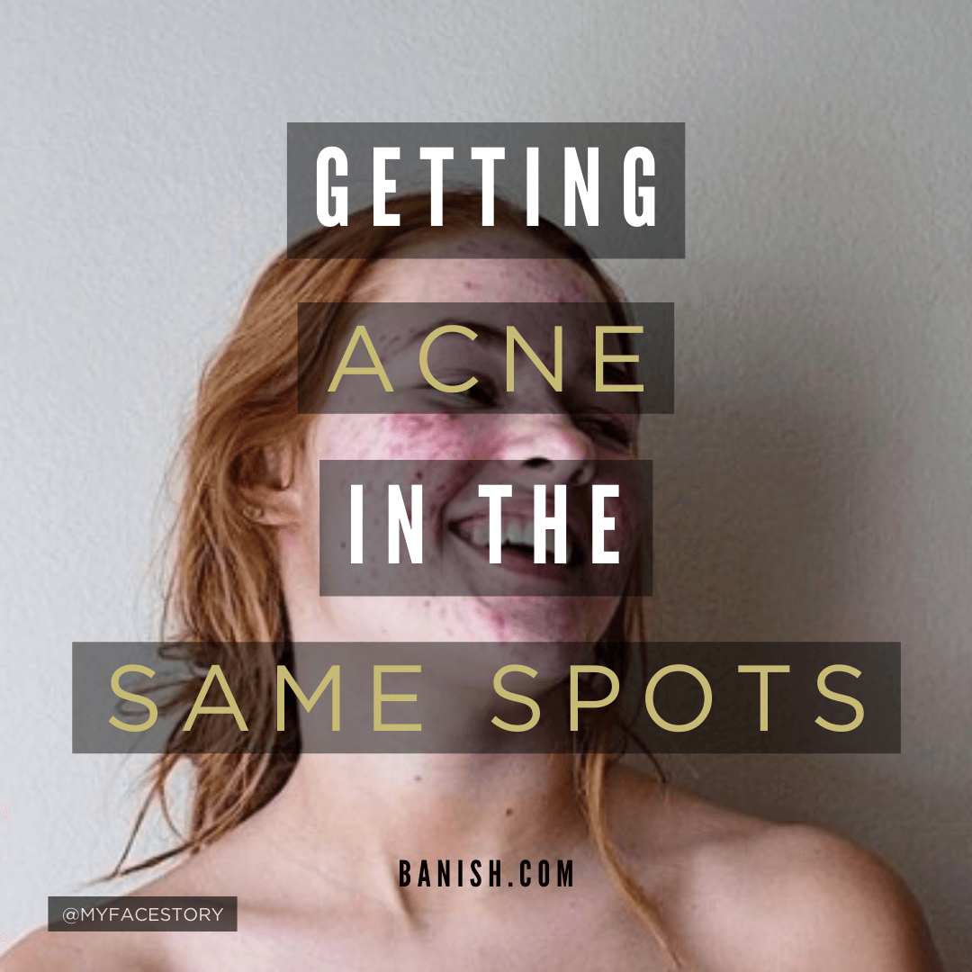 Why You Keep Getting a Pimple In the Exact Same Spot