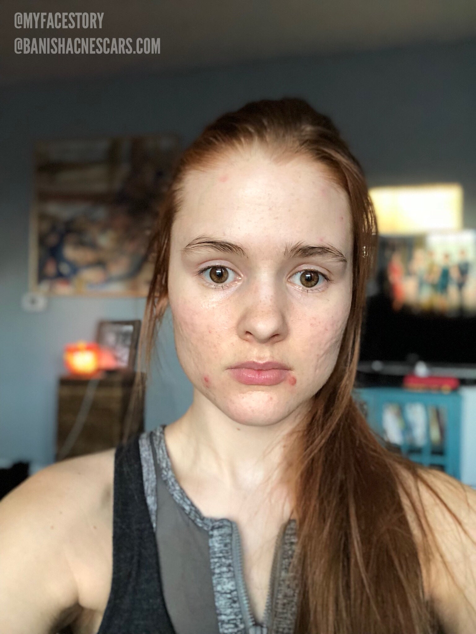 vaccination for acne