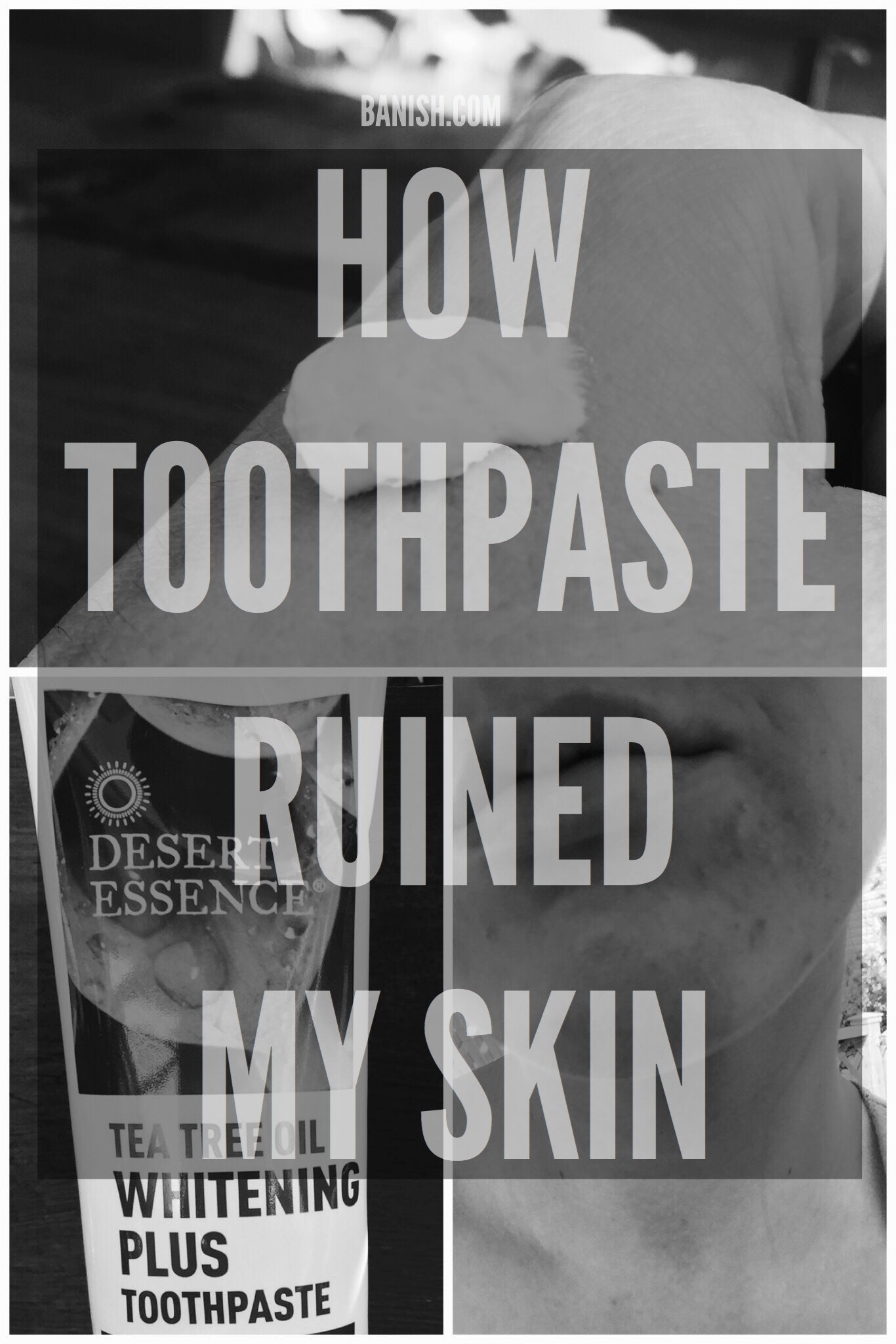 HOW TOOTHPASTE BROKE ME OUT AND RUINED MY SKIN