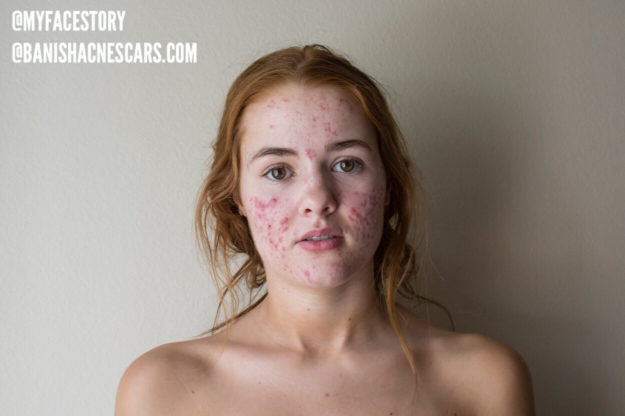 Psychological Effects of Acne