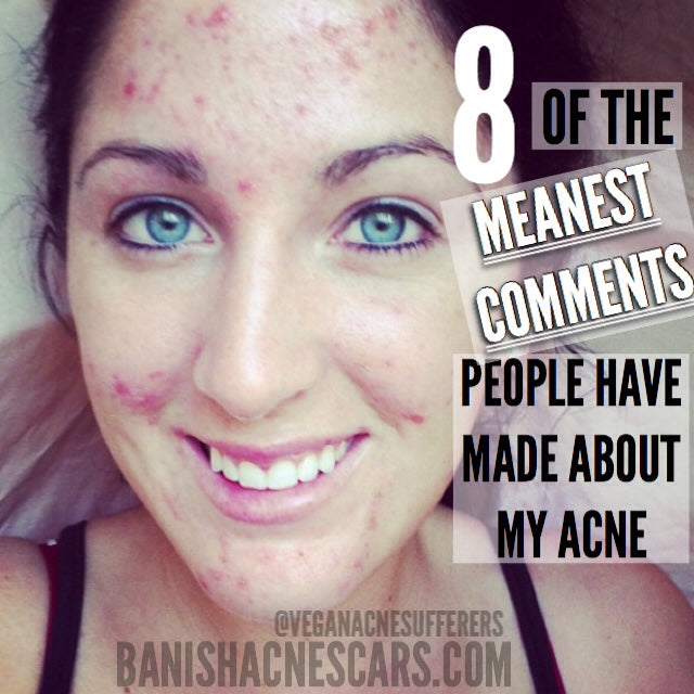 8 of the Meanest Comments People Have Made About My Acne