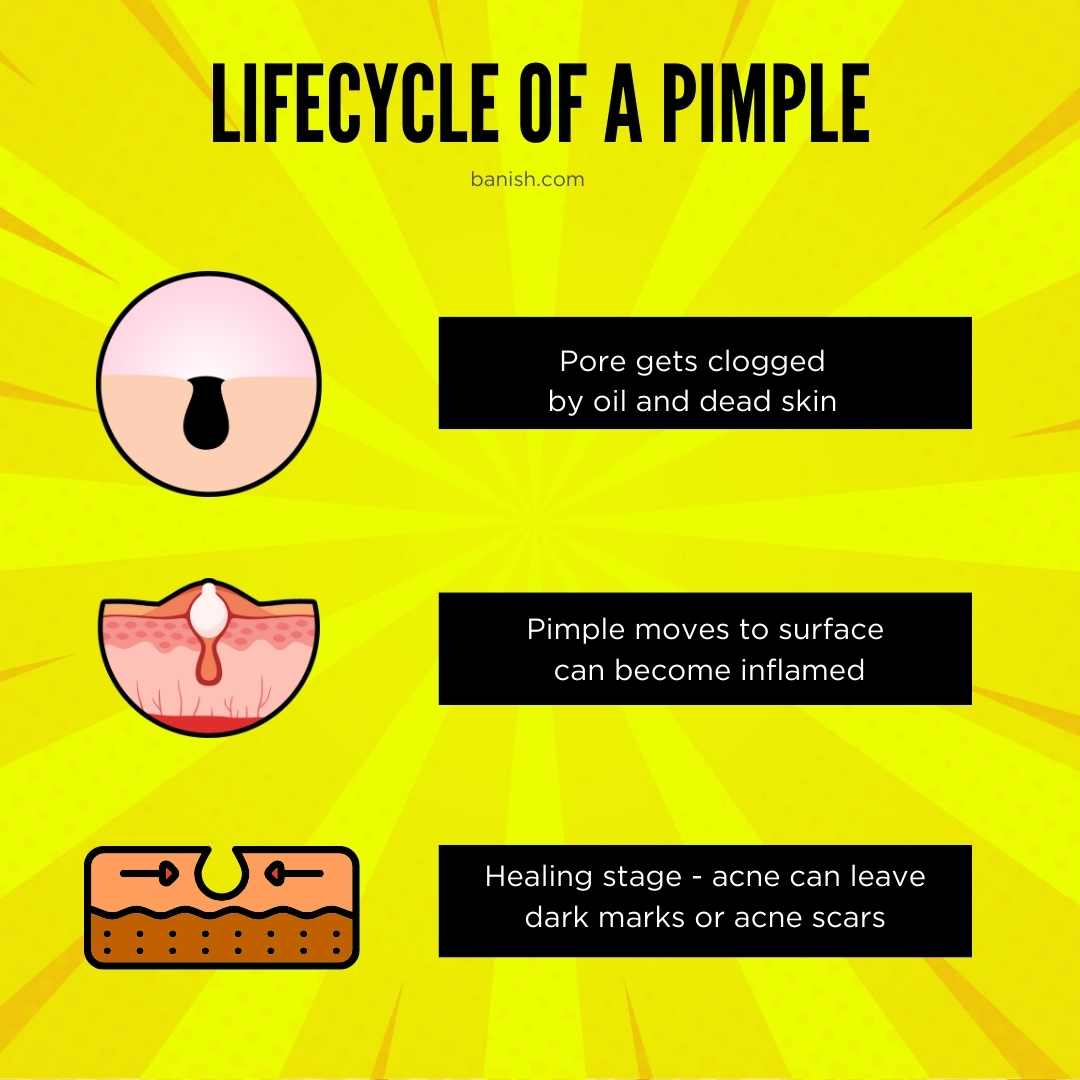 How Pimples Work The Lifecyle of A Pimple - what causes acne and how to stop it