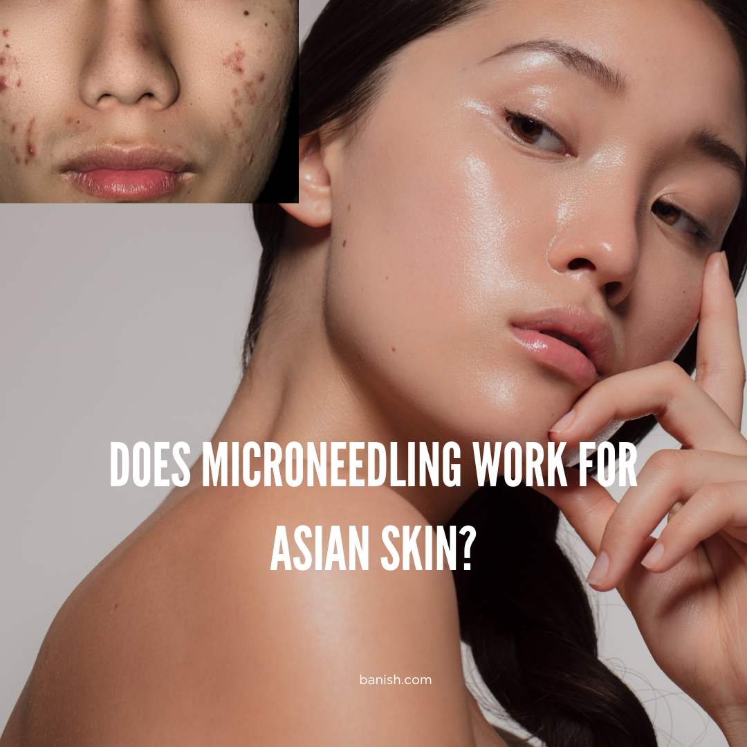 Is Microneedling Effective On Asian Skin?