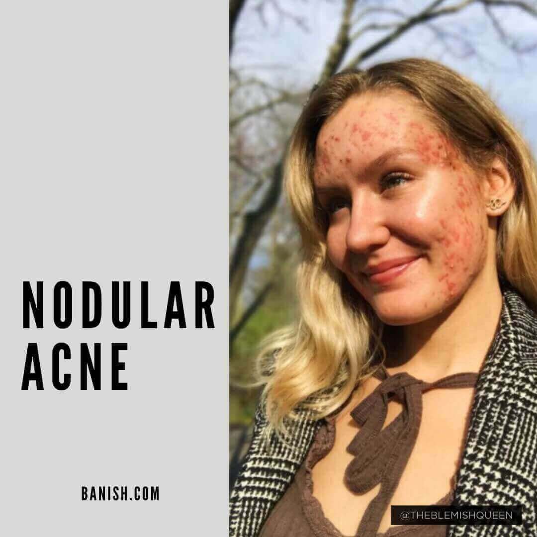 what is nodular acne