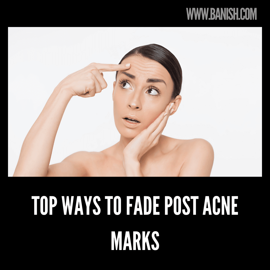 Top Ways To Fade Post Acne Marks