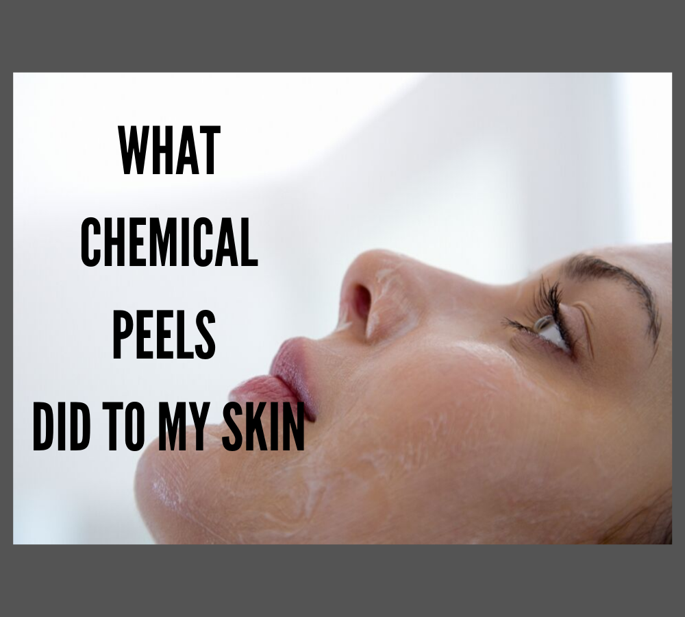 What Chemical Peels Did to my Skin