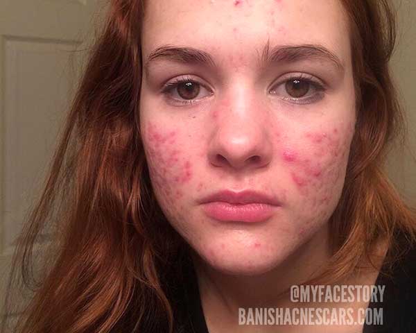 Accutane wo zu kaufen