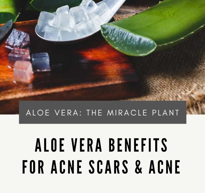 Aloe Vera For Acne : The Benefits and How To Use
