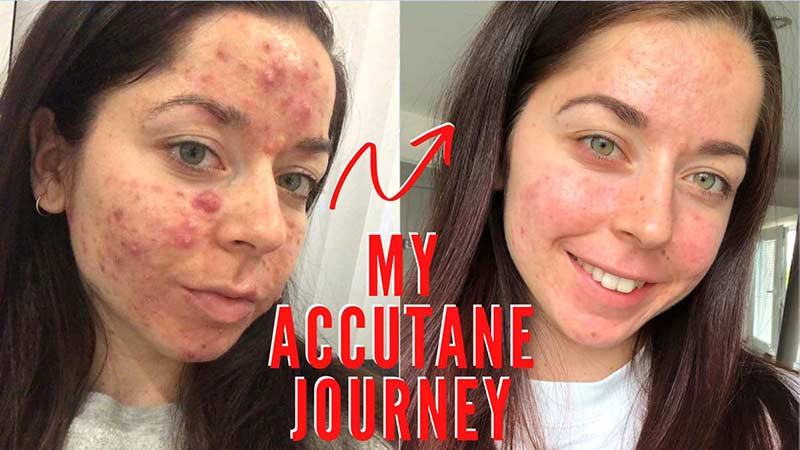 accutane journey