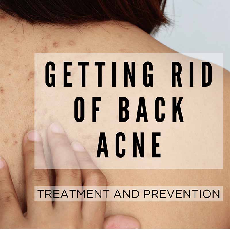 how to get rid of back acne