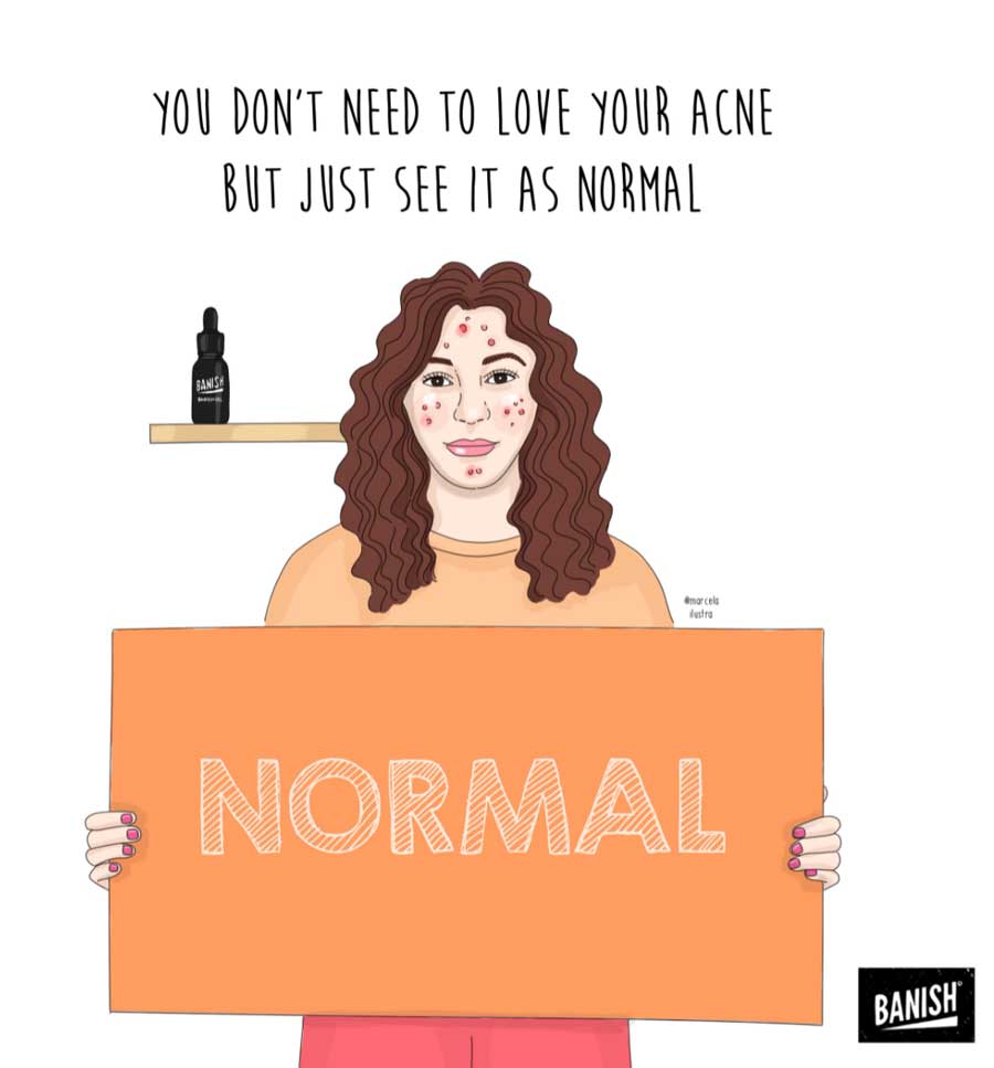 acne is normal  acne neutrality